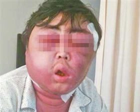 被蚊子叮一口男子脸肿成&ldquo;球&rdquo; 两月面部肿胀仍未消